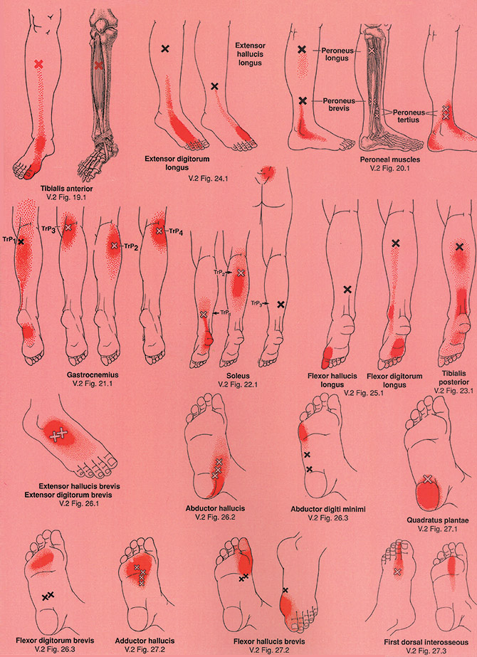 Trigger Point chart for Leg, Ankle, Foot Pain